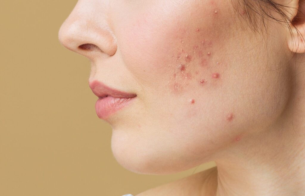 Acne Scarring Treatments