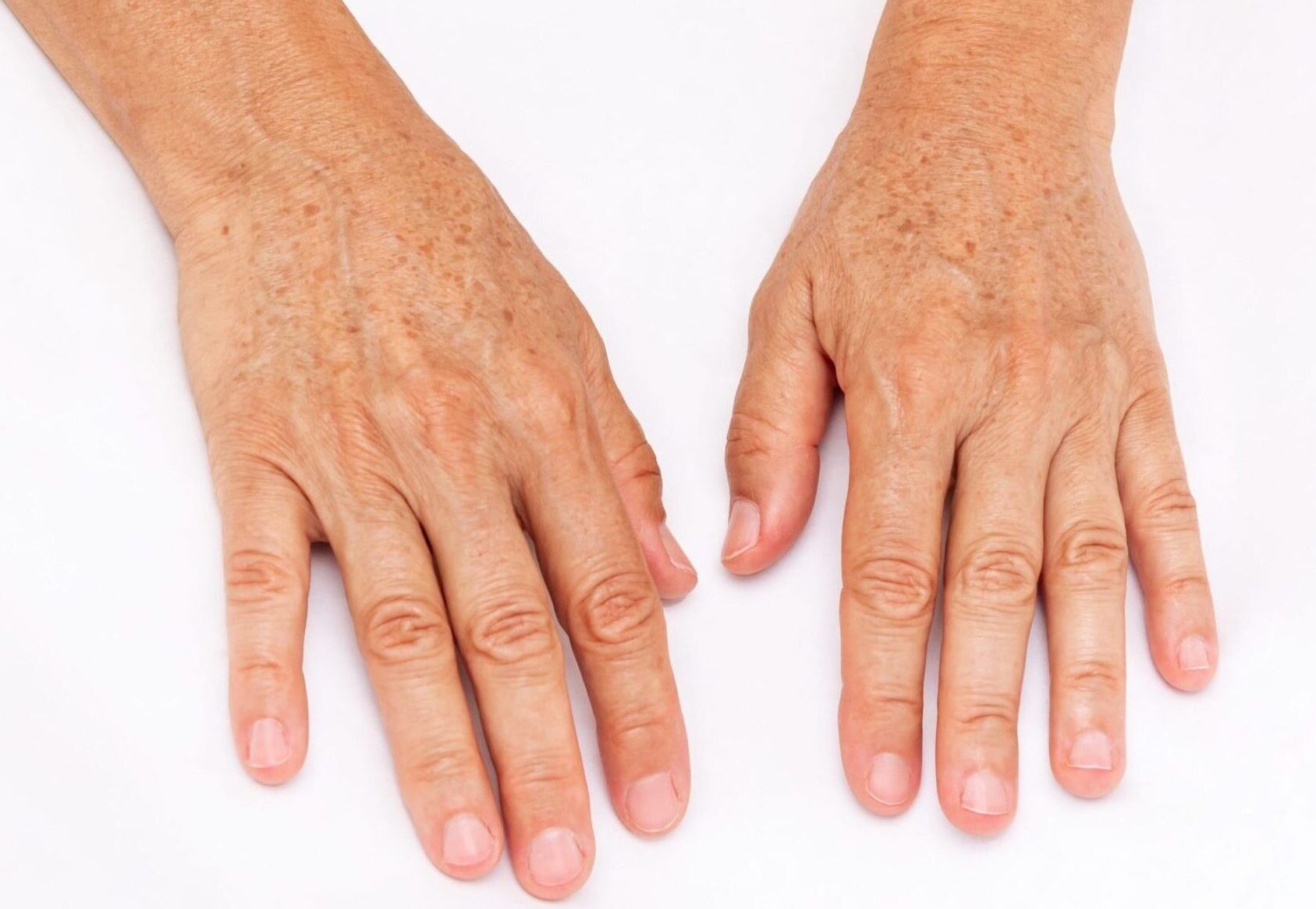 The,Hands,Of,Elderly,Woman,With,Pigmented,Spots,Isolated,On